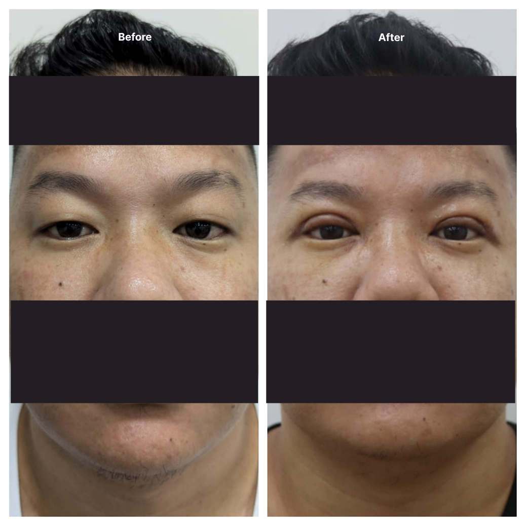 Eyelid Surgery KOQ10